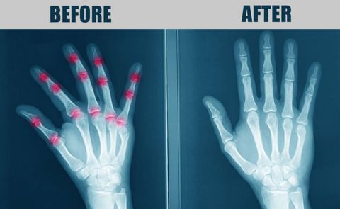 FDA Approved-At-Home Device That Helps Relieve Hand Arthritis Pain